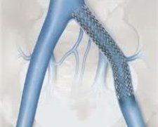 Cook Medical Zilver Vena Self Expanding Stent | Used in Vascular stenting, Venous stenting  | Which Medical Device